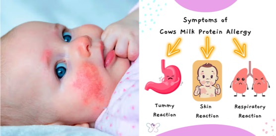 milk allergy infants dairynews7x7